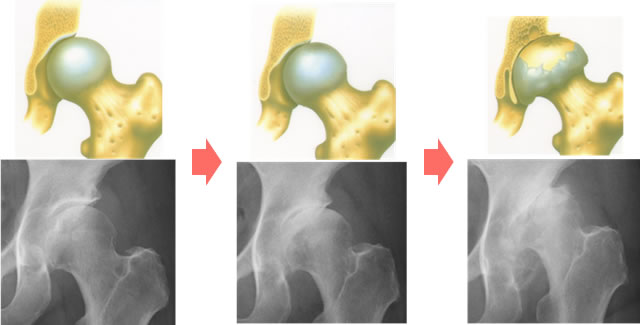 図2：変形性股関節症の進行。右側ほど、関節軟骨はすり減り、股関節症は進行している。