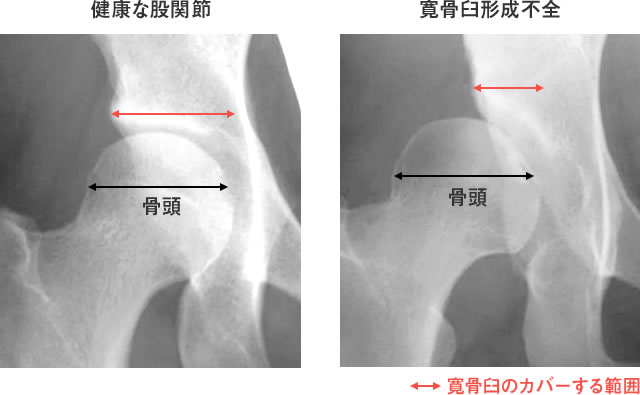 図3：健康な股関節（左）に比べ、寛骨臼形成不全(右)では、骨頭に対する寛骨臼のカバーする範囲（赤線）が狭い。