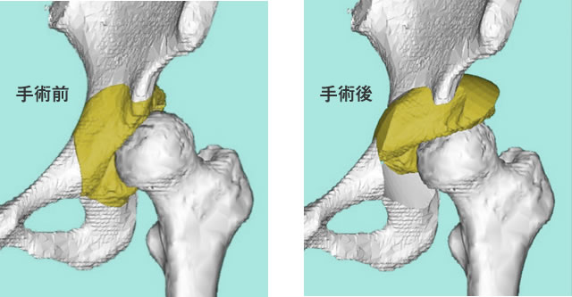 図7：寛骨臼回転骨切り術（緑の部分をくりぬいて移動し、骨頭をカバーする範囲を増やします）