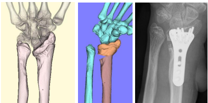 橈骨遠位端骨折後変形
