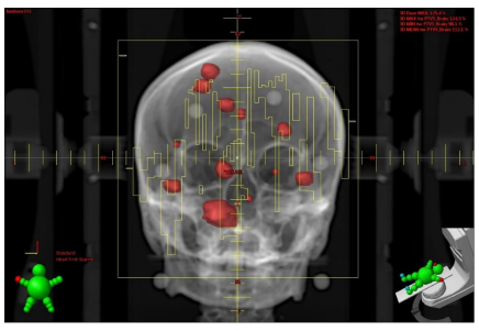多発脳転移に対する定位放射線治療