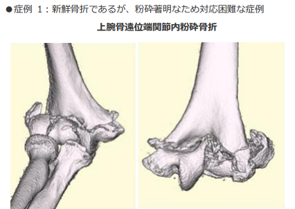 上腕骨遠位端関節内粉砕骨折