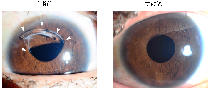眼内レンズ亜脱臼