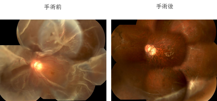 増殖硝子体網膜症