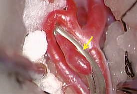 動脈瘤にカテーテルを挿入