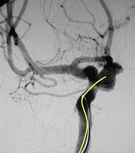 動脈瘤にカテーテルを挿入