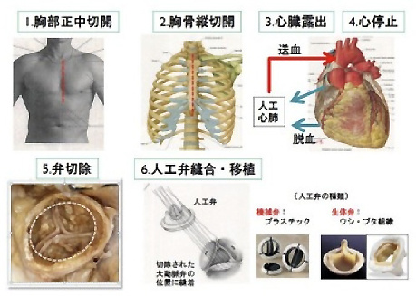 自己弁温存大動脈基部置換術