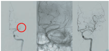 図5 閉塞していた左中脳動脈をステントリトリーバーで再通過させた