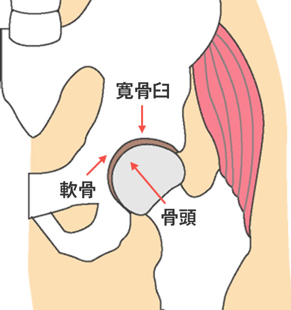 股関節の病気と治療 人工股関節手術 人工関節センター 大阪急性期 総合医療センター