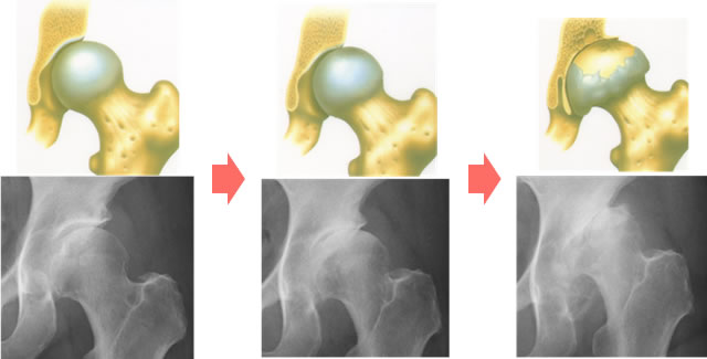 股関節 壊死