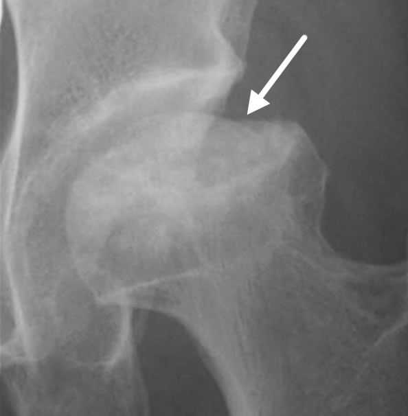 図4：骨頭がつぶれた(矢印) 大腿骨頭壊死症