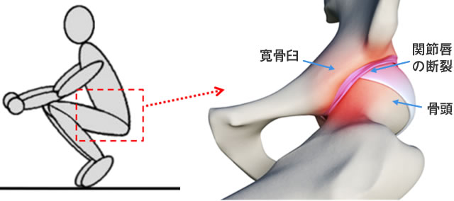 図5：大腿骨寛骨臼インピンジメント 引用：Houston Methodist Leading Medicine