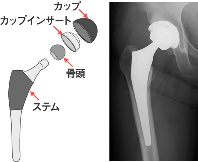 股関節の病気と治療 人工股関節手術 人工関節センター 大阪急性期 総合医療センター