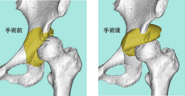 股関節の病気と治療 人工股関節手術 人工関節センター 大阪急性期 総合医療センター