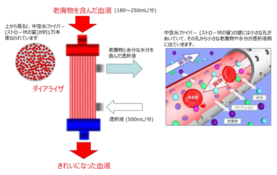 図1A. 血液透析の方法