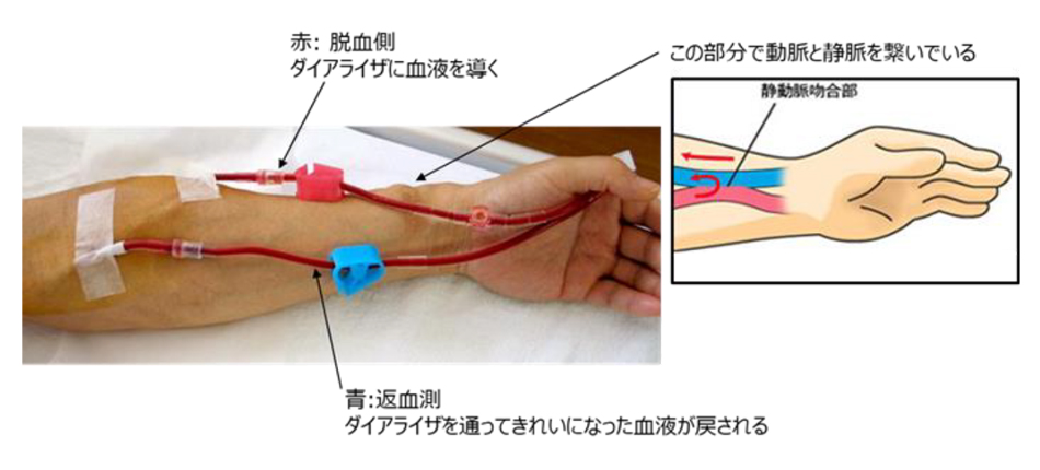 図2. 内シャント (脱血用と返血用の針を穿刺して透析中)