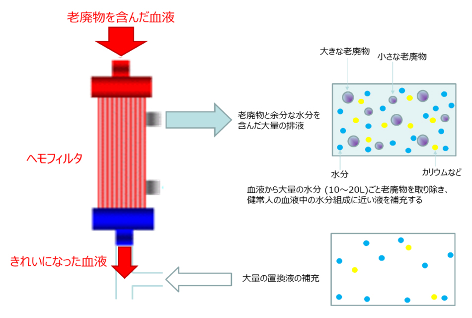 図1B. 血液濾過の方法