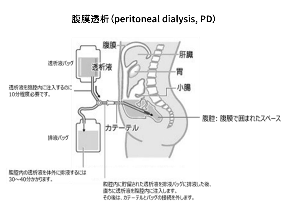 図3. 腹膜透析の方法