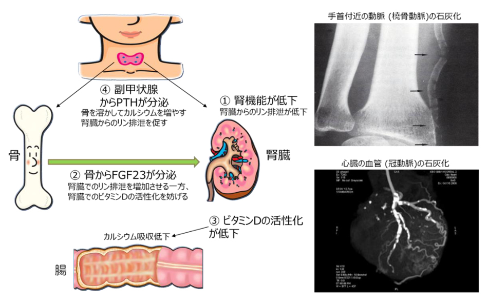 図10. 腎機能低下に伴う骨ミネラル代謝異常 (著者作成、イラストは中外製薬イラスト集より引用)